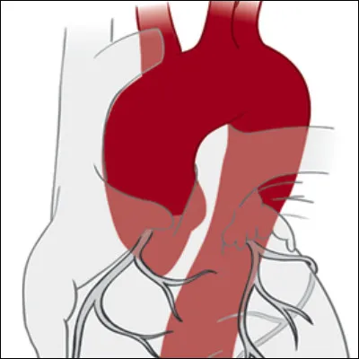 En linguistique, comment appelle-t-on une succession de deux voyelles dans des syllabes diff&eacute;rentes, comme dans le mot aorte ?
