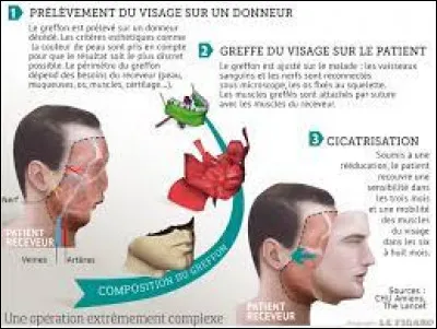 Comment s'appelle la Française qui a bénéficié de la première greffe partielle du visage ?