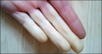 Comment appelle-t-on ce phénomène vasomoteur, dû à un trouble de la circulation sanguine ? Il est primitif (sans cause retrouvée) dans la plupart des cas mais peut parfois être secondaire à la prise de médicaments (vasoconstricteurs...), à une sclérodermie systémique ou encore à une maladie professionnelle (maladie des engins vibrants...) etc.