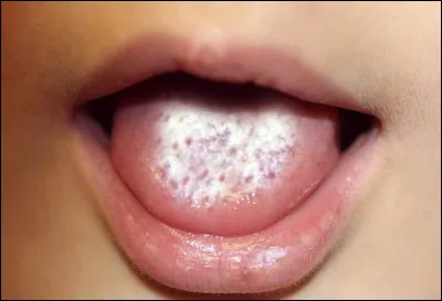 Que vous évoque une langue à la coloration blanchâtre ?