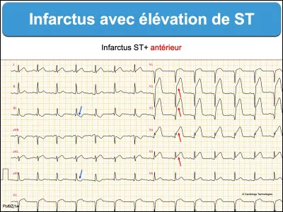 Un patient de 55 ans, tabagique, se présente aux urgences devant l'apparition d'une douleur thoracique en barre irradiant dans la mâchoire survenue alors qu'il se trouvait sur son canapé. Quel examen devez-vous réaliser en urgence ?