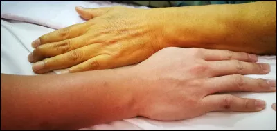 Quel produit de dégradation de l'hémoglobine est à l'origine d'un ictère (coloration jaune des téguments) lors d'une angiocholite par exemple (infection des voies biliaires lors d'une obstruction de la voie biliaire principale) ?