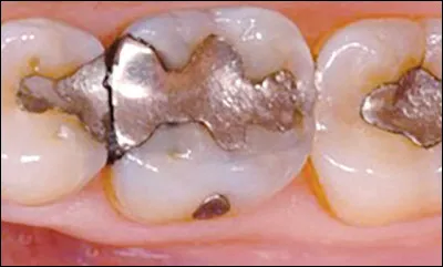 Lamalgame dentaire ne contient pas de plomb comme on pourrait le penser, quel métal contient-il ?