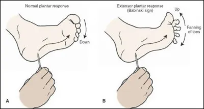 Le signe de Babinski, que l'on recherche lors de l'examen neurologique, désigne le mouvement d'extension ''lente et majestueuse'' du gros orteil lors de la stimulation de la plante du pied. Caractéristique d'une atteinte des voies motrices du faisceau pyramidal lors d'un AVC par exemple !
Il est habituellement positif chez le bébé jusqu'à l'âge de 6 mois.