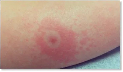 Une petite révision pour les joueurs de mon quiz précédent (je ne force personne, hein^^). De quelle pathologie l'érythème migrant est-il caractéristique ?