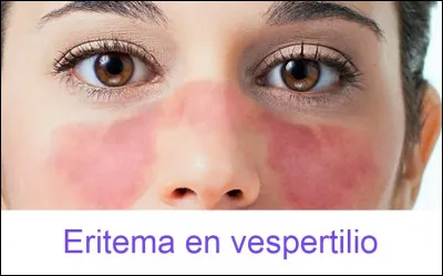 Le lupus, cher au Dr. House, est une maladie systémique, ce qui signifie qu'elle peut se traduire de mille et une manières différentes... L'atteinte cutanée typique (vespertilio) lors d'une exposition au soleil se manifeste par un érythème facial dit...