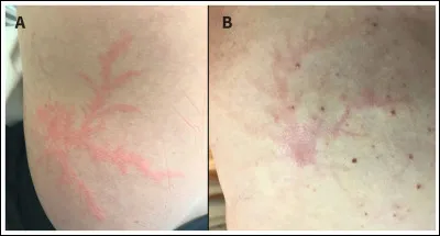 La présence sur la peau de figures de Lichtenberg est caractéristique...