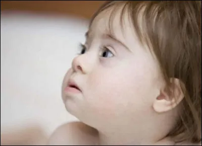 Lequel de ces noms correspond à la trisomie 21 ?