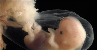 Quel est le poids de naissance moyen des malades du syndrome de Bloom ?