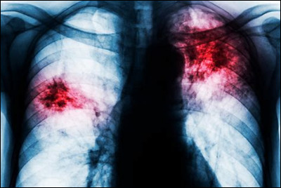 Quel syndrome est juste après la tuberculose sur l'échelle mondiale des causes de mortalité d'origine infectieuse ?