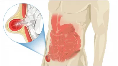 Science : Comment appelle-t-on une sortie d'organe de la cavité où il se trouve normalement ?