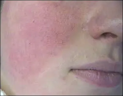 Que faut-il ajouter à "ros" pour obtenir le nom d'une maladie cutanée chronique caractérisée par une atteinte des petits vaisseaux sanguins du visage ?