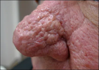 Quel est le nom de cette hypertrophie plus ou moins inflammatoire du tégument du nez ?