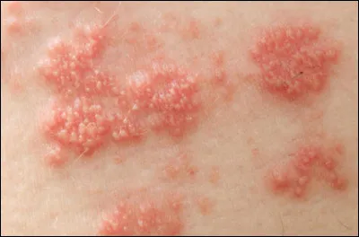 Z comme zona : le zona est une dermatose virale, le même virus que ...