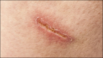 Le héros a une cicatrice