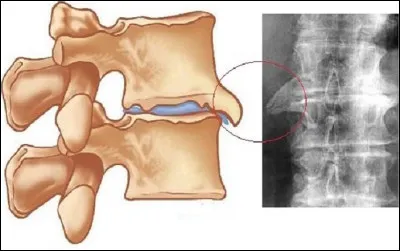 Quel nom donne-t-on communément à une excroissance osseuse due à une calcification non voulue autour des vertèbres ?