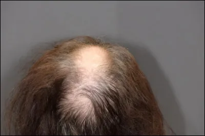 Comment appelle-t-on l'accélération de la chute des cheveux ou des poils ?