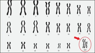 Quelle maladie a une personne ayant ce type de caryotype ?