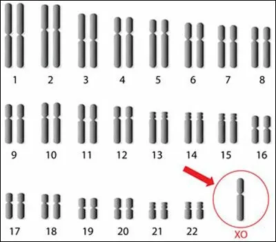 Quelle maladie a une personne ayant ce type de caryotype ?