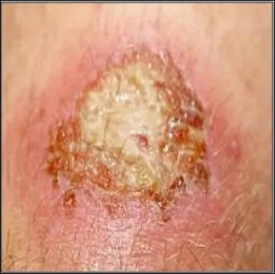 Qu'est-ce que la suppuration ?