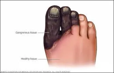 Vous avez une blessure au pied qui s'est infect&eacute;e gravement et vire &agrave; la gangr&egrave;ne. Que comptez-vous faire &agrave; ce sujet ?