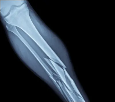 Juin : Qui était atteint de la maladie des os de verre ?