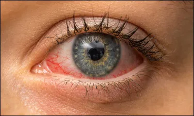 Cataracte : quels sont les principaux symptômes de la cataracte due à l'âge ?