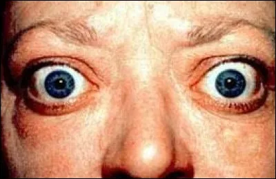 Santé : Quel organe est affecté en cas de maladie de Basedow ?