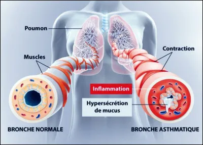 À long terme, la bronchiolite du nourrisson, qui se transmet sur un mode épidémique saisonnier, peut entraîner chez l'enfant...