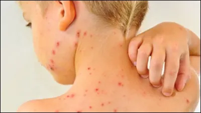 Quel médicament, déconseillé en dessous de l'âge de 16 ans, est formellement contre-indiqué chez les enfants atteints de la grippe, varicelle ou même d'un rhume ?