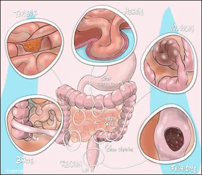 Certes vieillie mais amusante, quelle expression pouvait autrefois désigner une occlusion intestinale ?