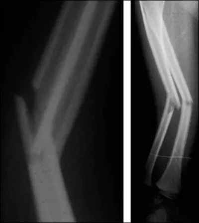 Quel est le nom de cette fracture à l'appellation bien inspirée ?