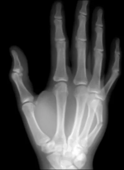 Une 2e fracture, appelée à raison la ''fracture du couillon'', qui, typiquement sur un accès de colère, frappe de toute ses forces contre un mur ou une baie vitrée. Quel métacarpien est atteint ici ?