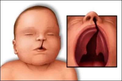 Comment est appelée cette malformation du palais ?