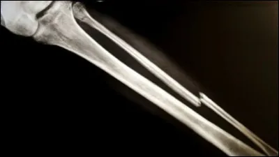 Quel remède renforce les os brisés ?