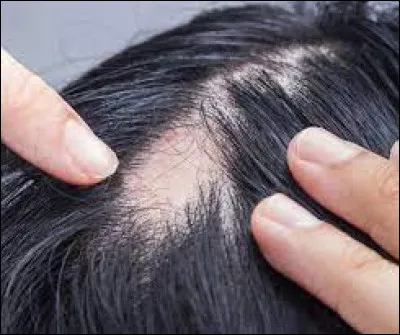 Quel terme désigne une accélération de la chute des cheveux ?