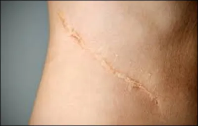 Sur quelle partie du visage préférerais-tu avoir une cicatrice ? (2)