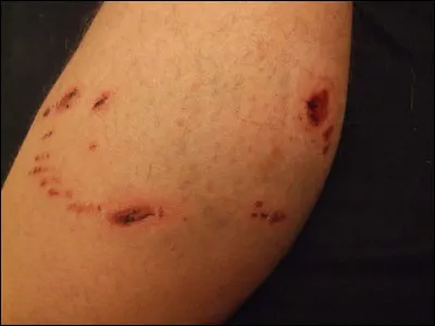 Brenda se fait mordre à la suite d'une attaque de fondus. Où ?