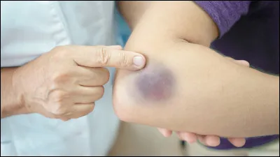 Quel est l'autre nom donné au bleu, une lésion sans rupture se caractérisant par une couleur bleutée ?