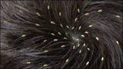 Comment nomme-t-on l'infestation par les poux chez l'être humain ?