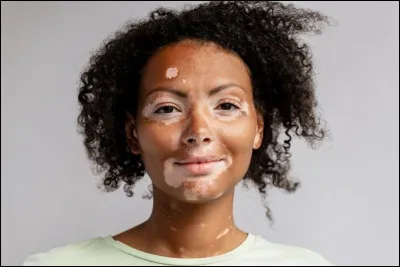En quoi consiste la maladie de peau appelée ''Vitiligo'' ?