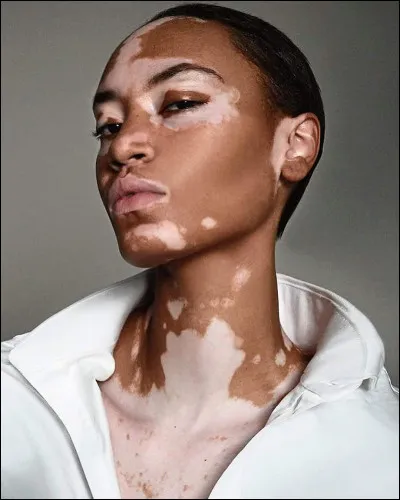 Les humains sont les seuls à pouvoir contracter le vitiligo.