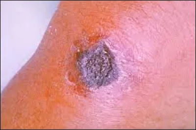 Quel autre nom donne-t-on à la maladie du charbon ?