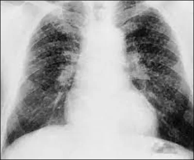 Quelle maladie pulmonaire provoquée par linhalation de fines particules de charbon est appelée la maladie du mineur ?