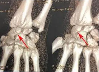 Quel nom porte cet os situé dans le carpe au niveau du poignet ?