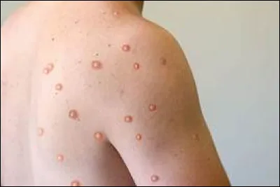 En 2004, dans quel pays des échantillons de ce virus variolique ont-ils été découverts dans un livre ?