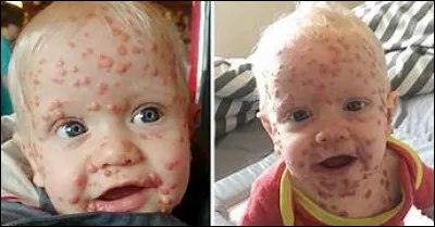 Dès quel siècle les Chinois ont-ils commencé à pratiquer la variolisation ?