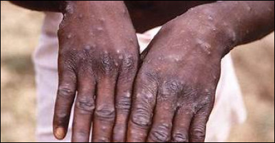 Comment la variole est-elle parfois surnommée ?