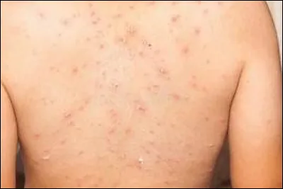 En combien de poussées les lésions se développent-elles dans le cas de la variole ?