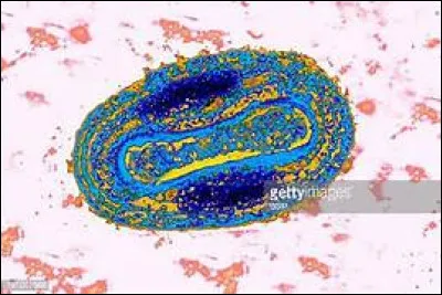 Où retrouve-t-on quasi exclusivement les pustules dans le cas de la forme semi-confluente de la variole ?